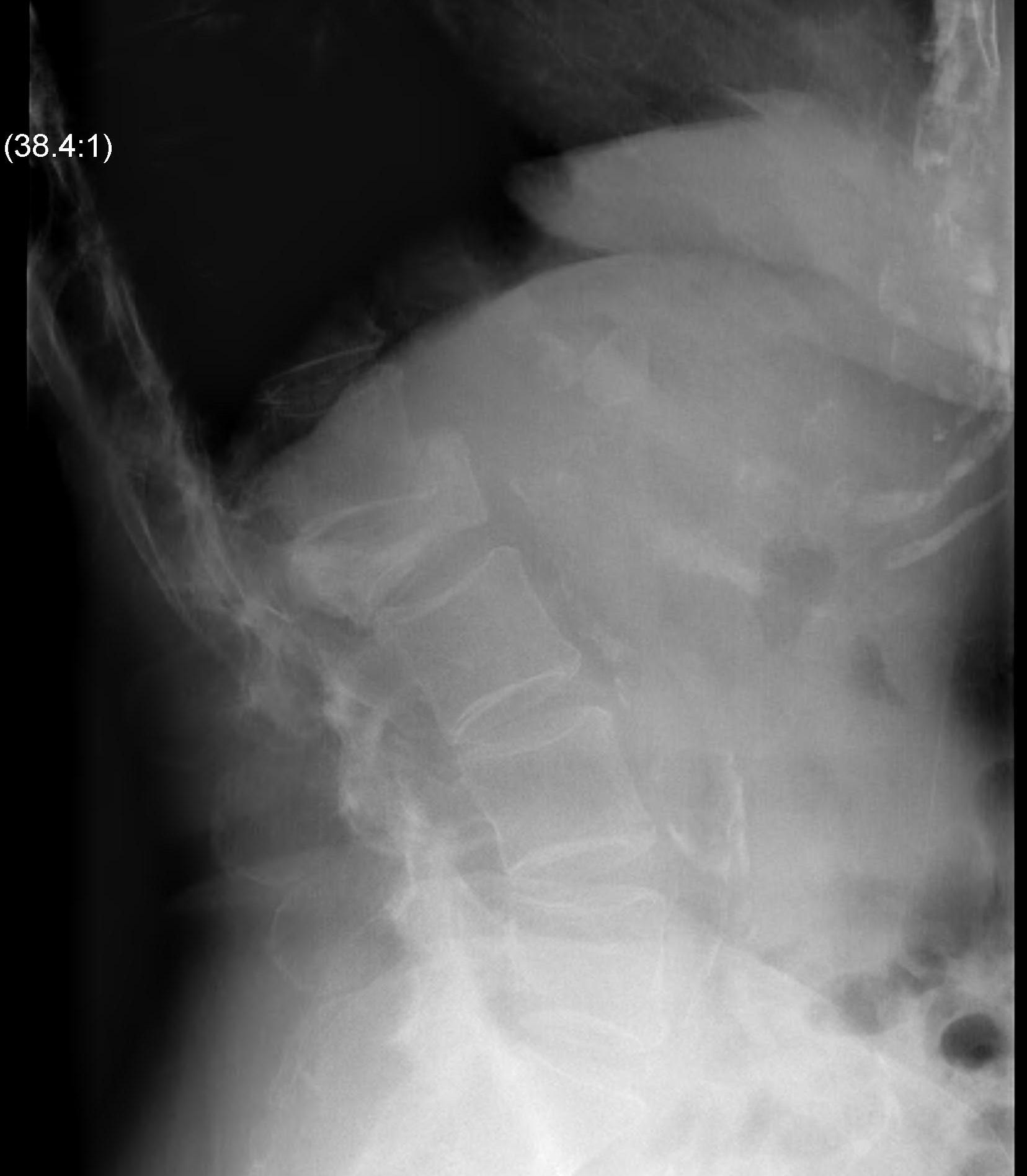 Lumbar Metastasis Xray